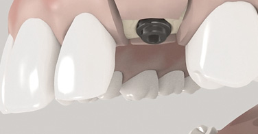 Zahnarzt Schwäbisch Gmünd, 3D Animation für den Einsatz eines Zahnimplantats in einem Schritt