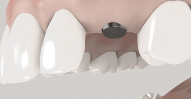 Zahnarzt Schwäbisch Gmünd, 3D Animation für den Einsatz eines Zahnimplantats in 2 Schritten